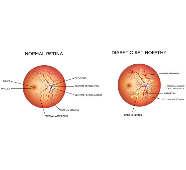 Diabetic retinopathy