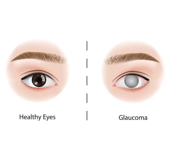 Glaucoma surgery