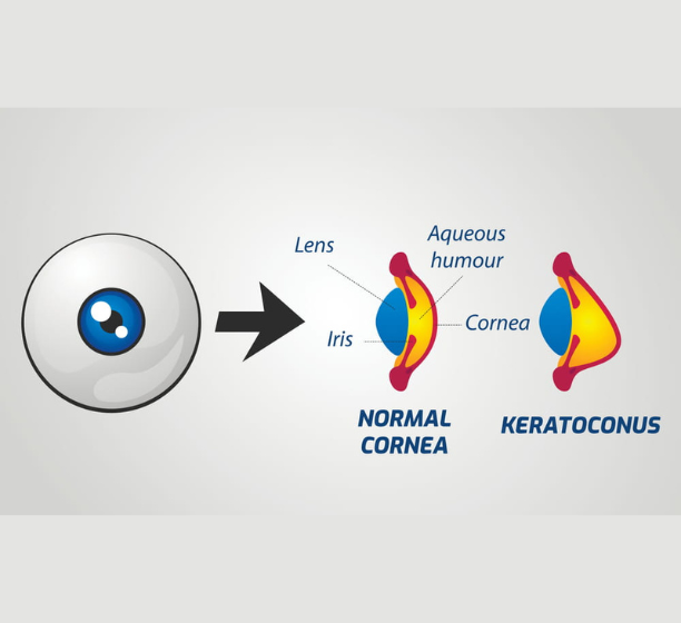 Keratoconus Treatment