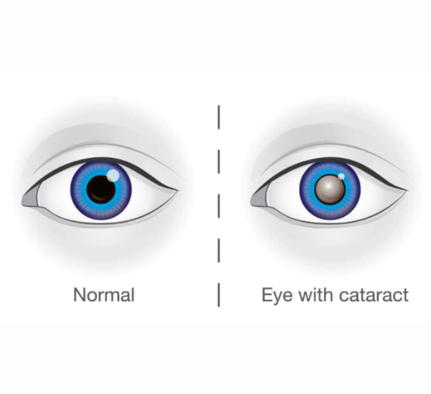 Cataract surger